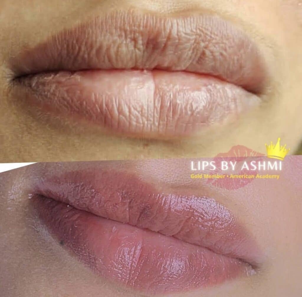 lip blushing treatment in andhra pradesh