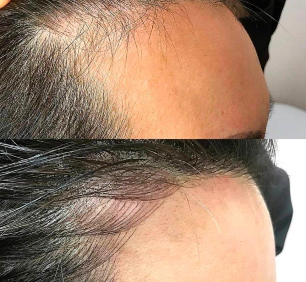 Scalp Micro Pigmentation for Hair Loss