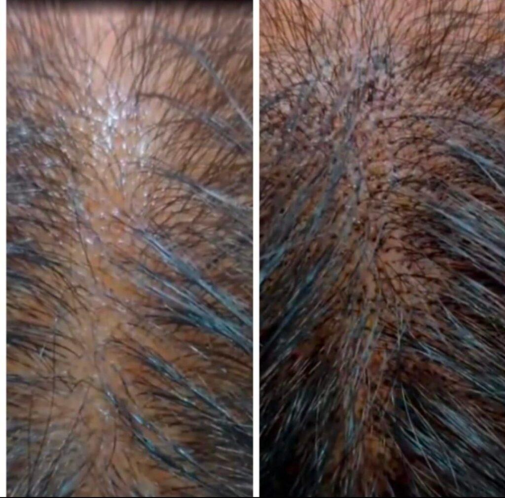 scalp micropigmentation near me