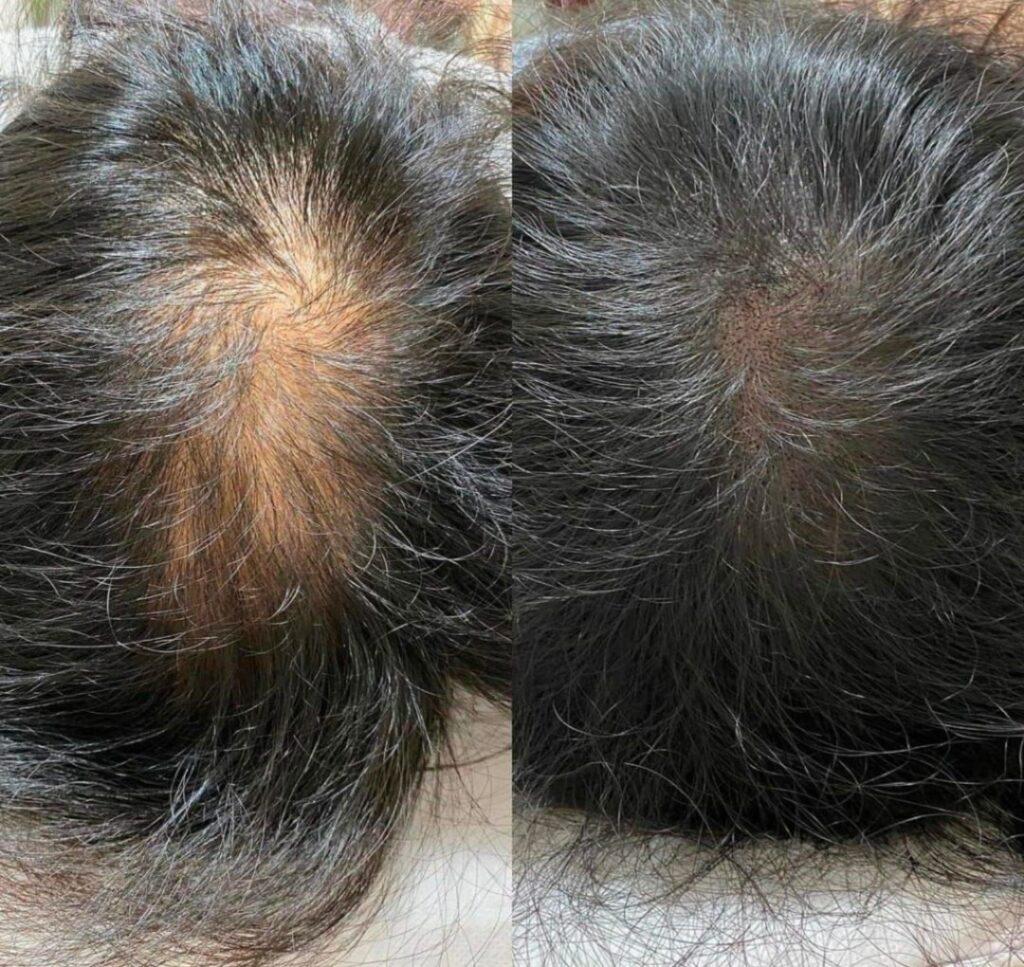 Scalp Micropigmentation in Mumbai