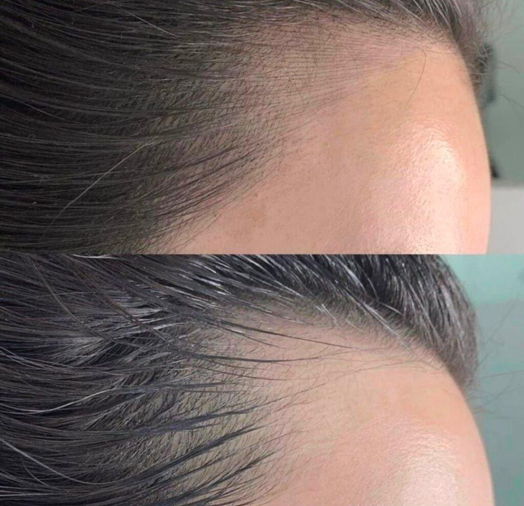 Scalp Micropigmentation India