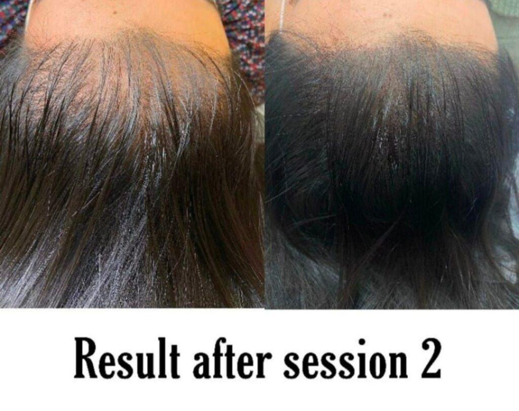 Scalp Micropigmentation in Mumbai