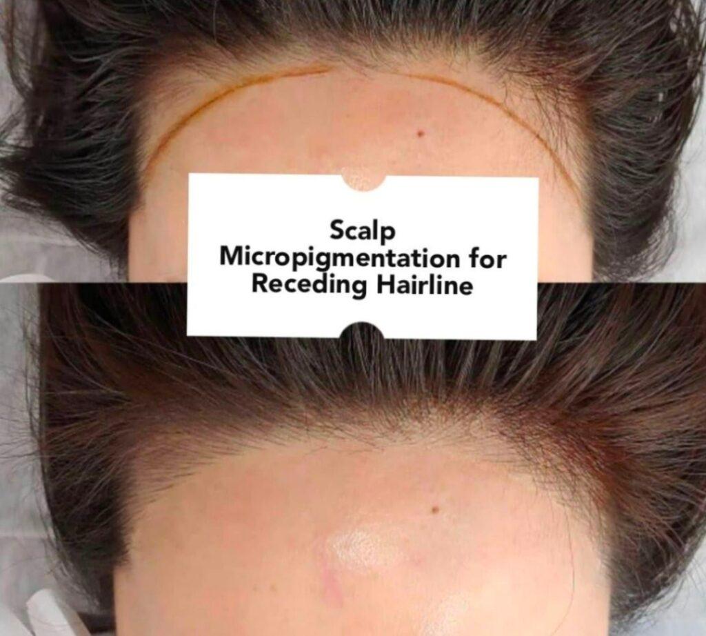 Scalp Micropigmentation