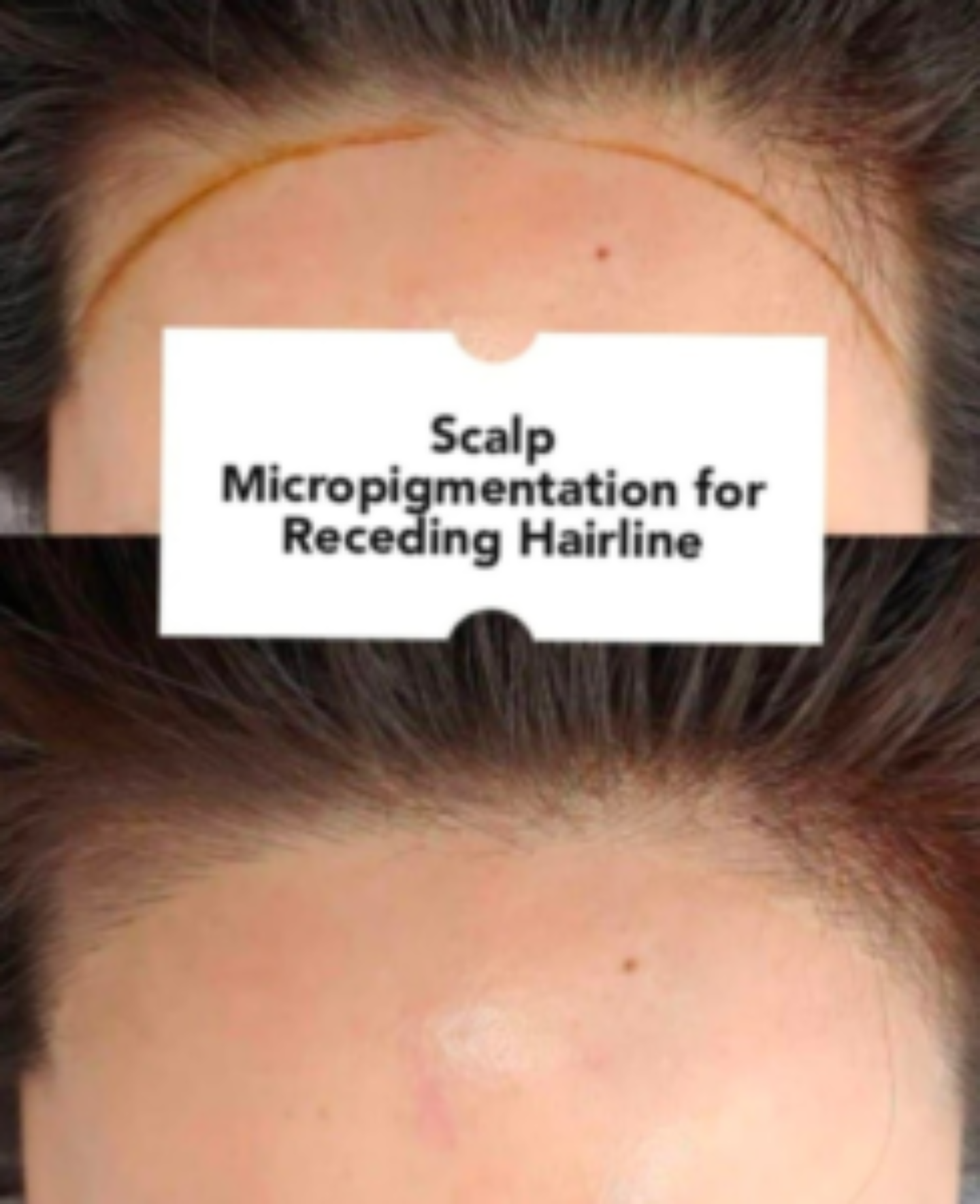 Scalp Micropigmentation Treatment in mumbai