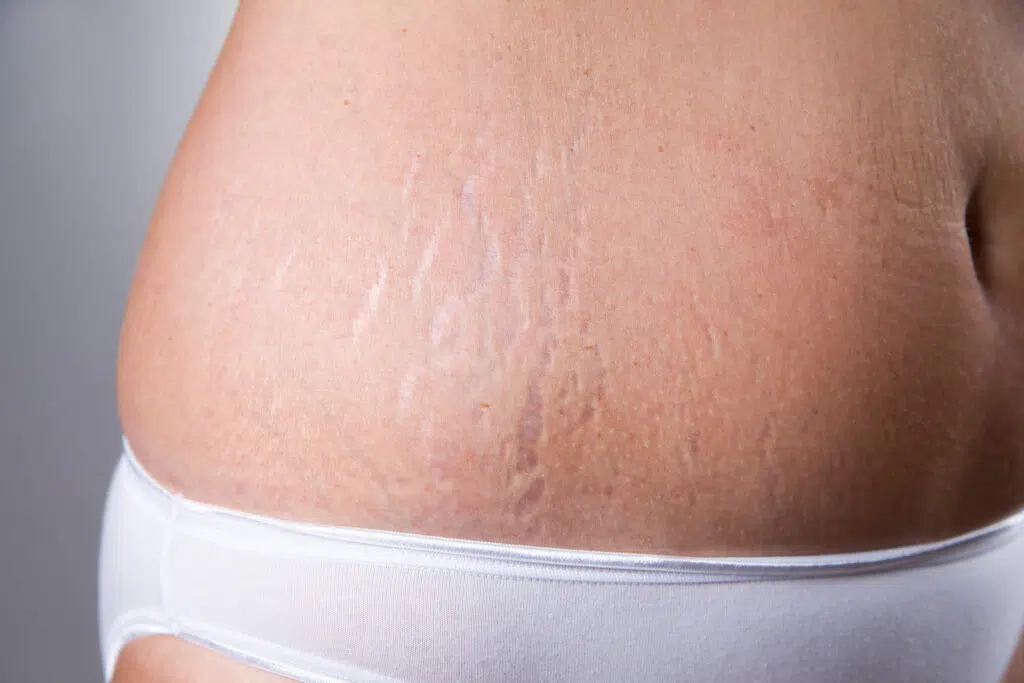 stretch marks service at thebrowmasters