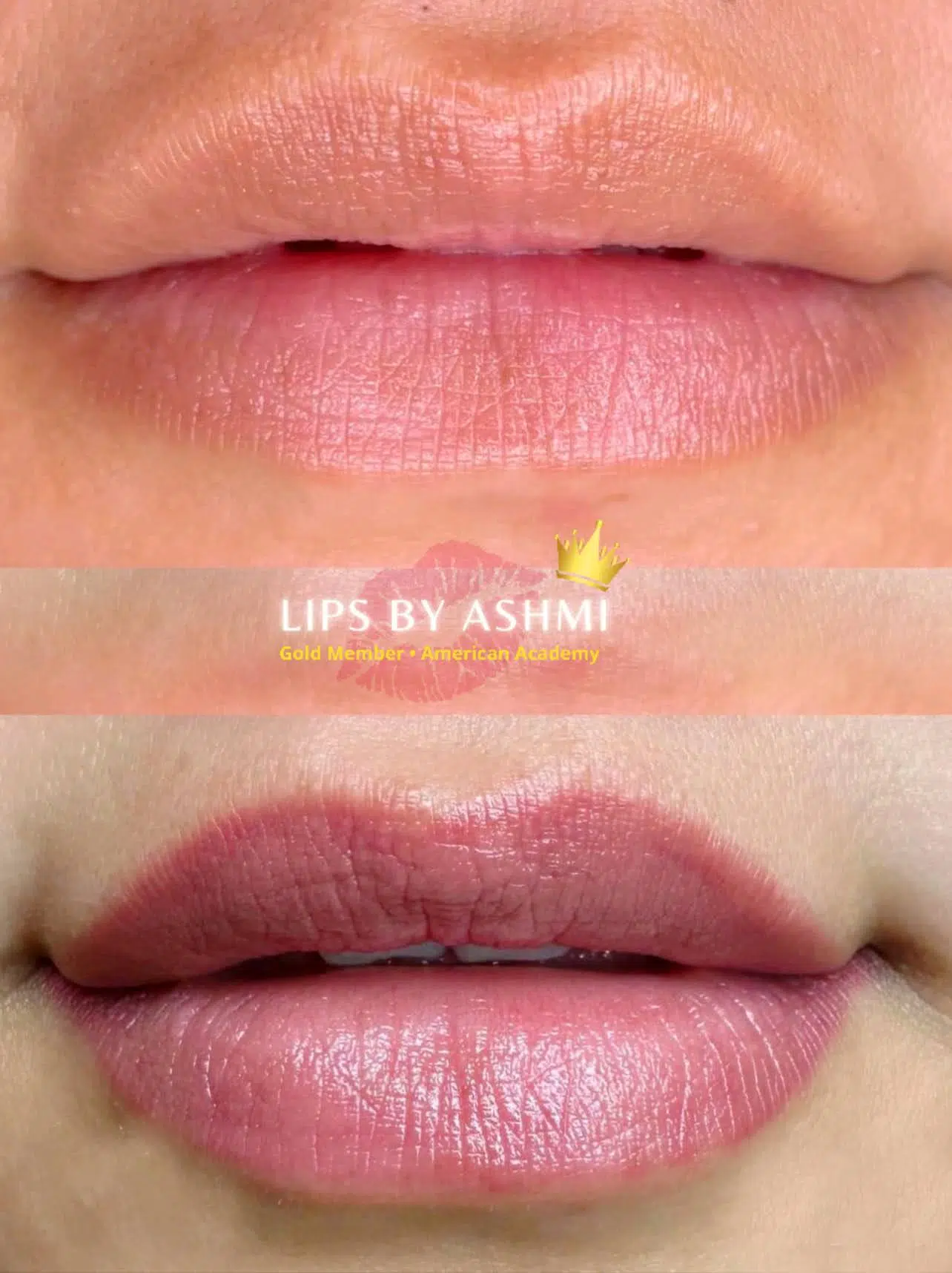 Best lip blush treatment in mumbai