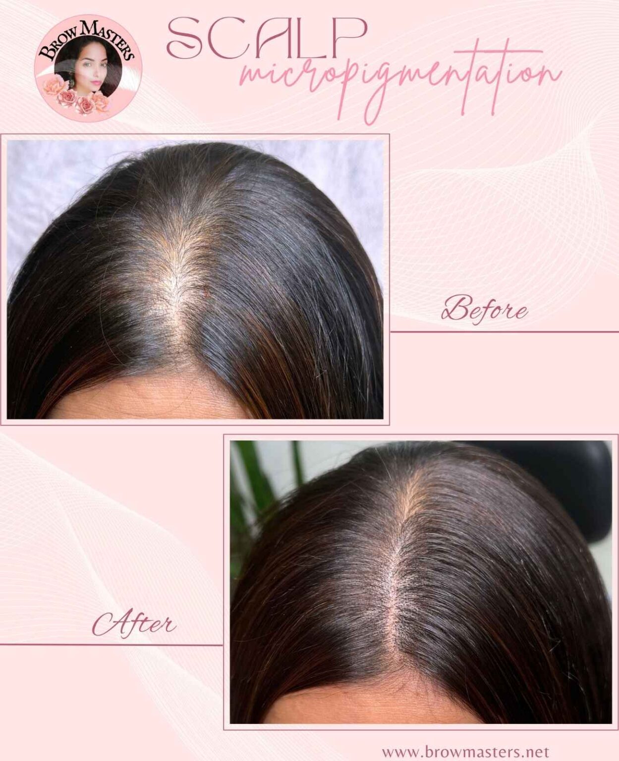 scalp-micro-pigmentation-mumbai-india