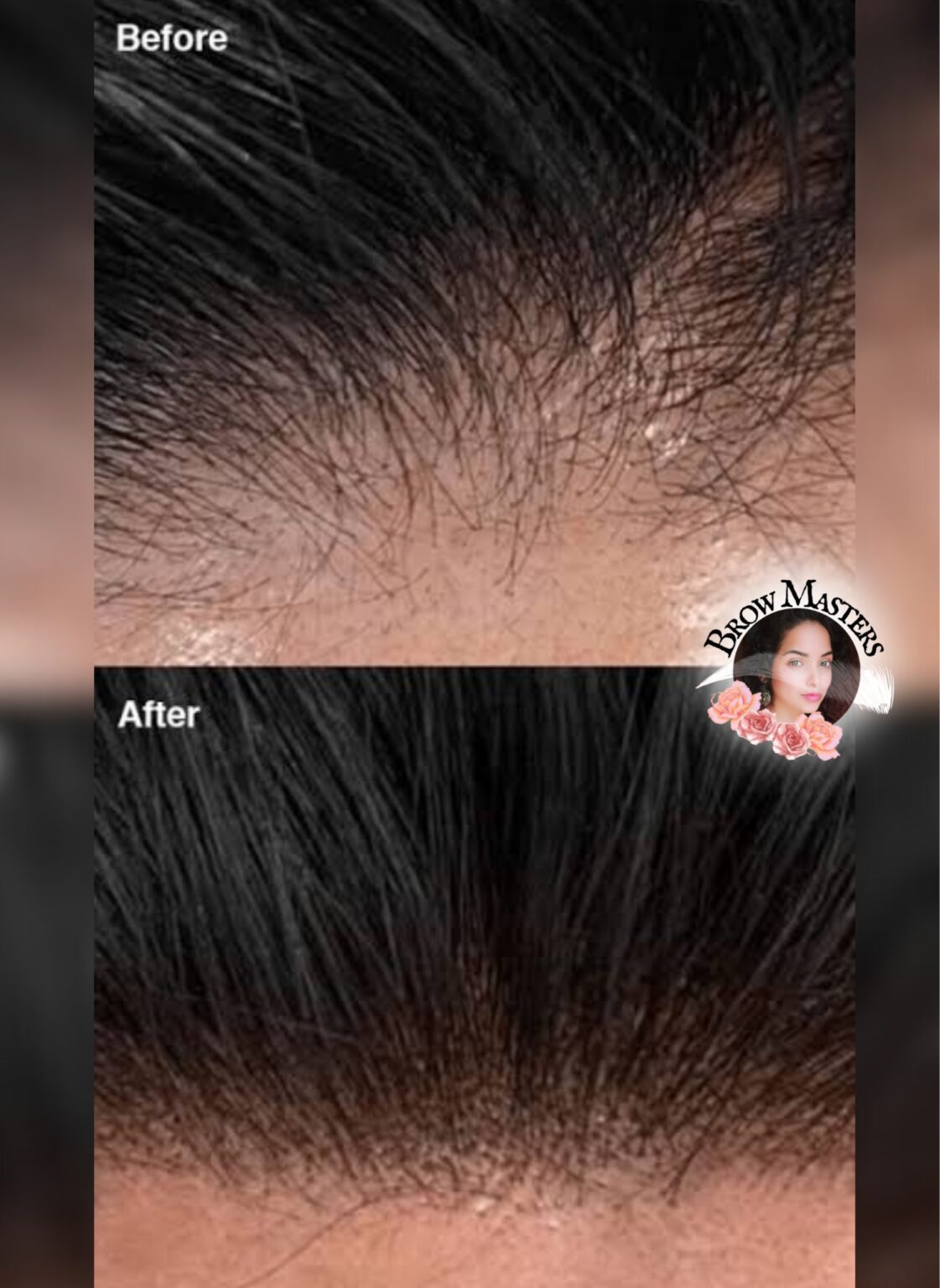 micropigmentation-of-scalp