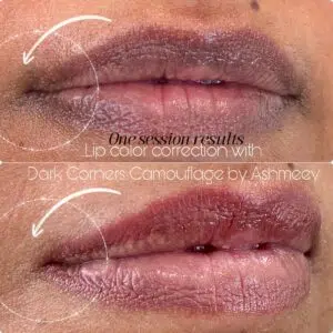 dark-lip-treatment