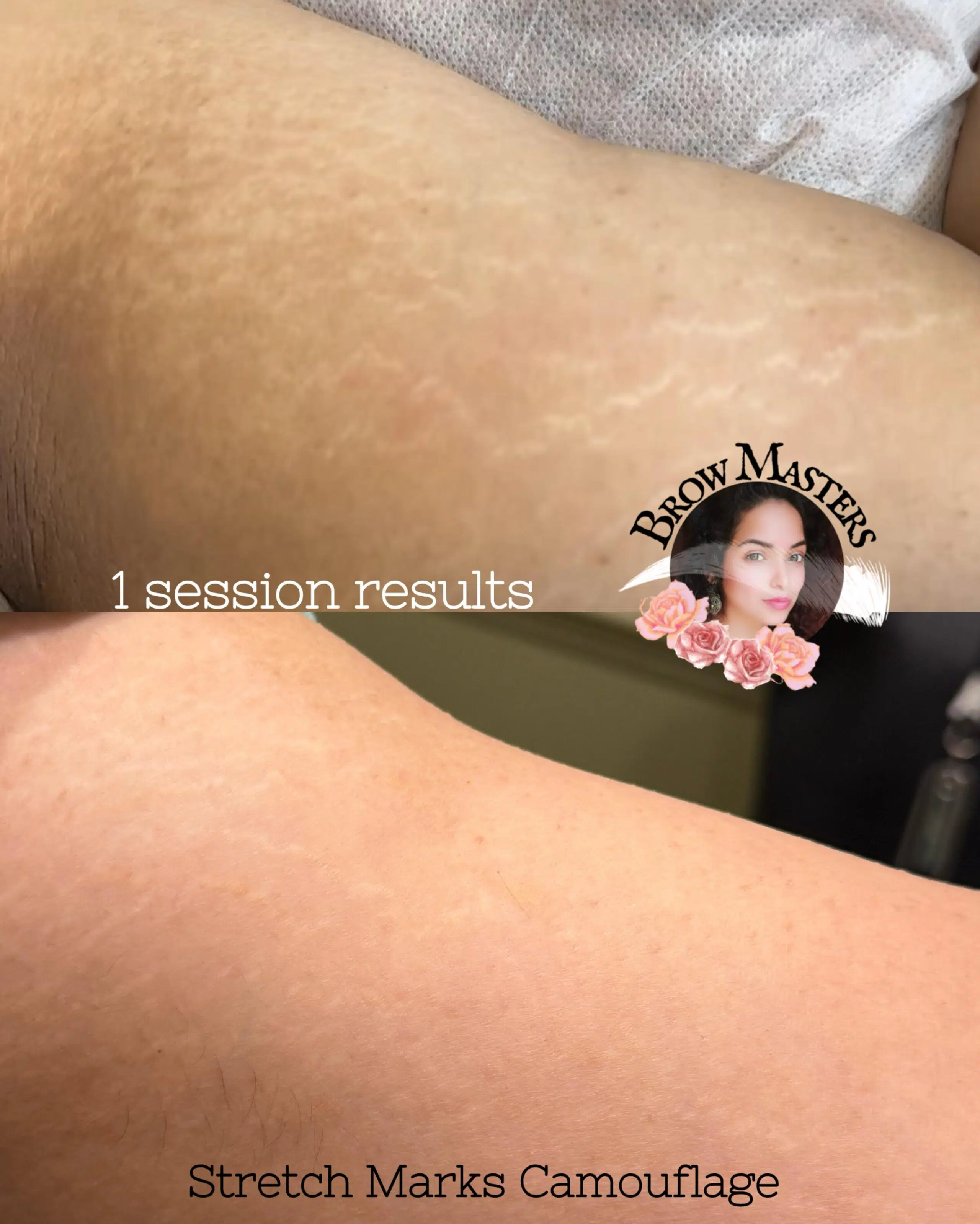 cosmetics-stretch-marks-treatment