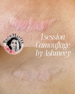 skin-treatment