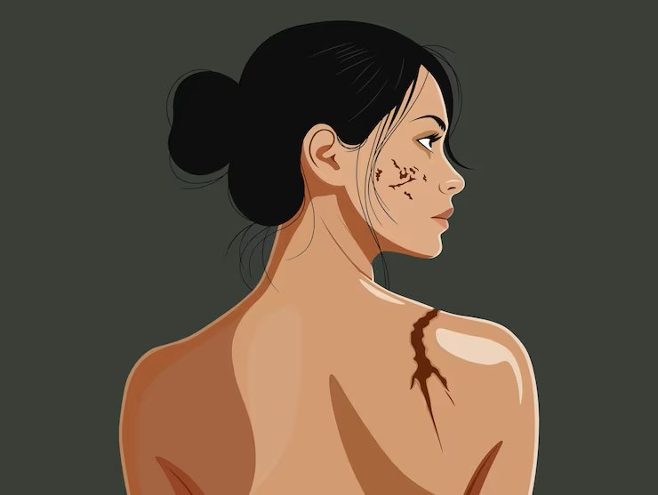 scar-camouflage-treatment-india