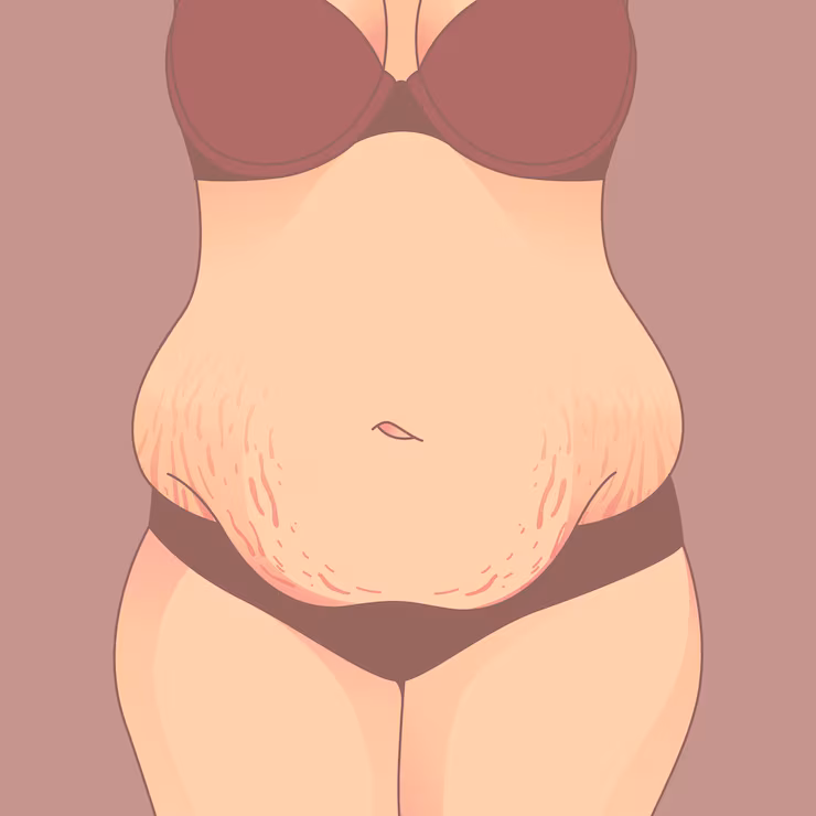 Stretch Marks Treatment Price